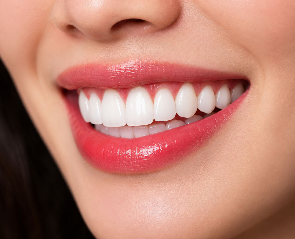 Răng sứ Orodent White Matt - Ý