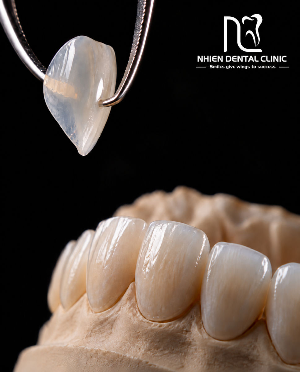 veneer nha khoa nhien 1.jpg