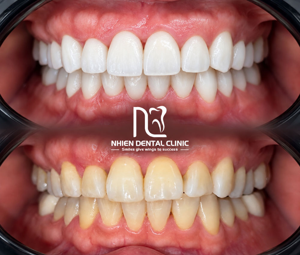 veneer nha khoa nhien 3.jpg