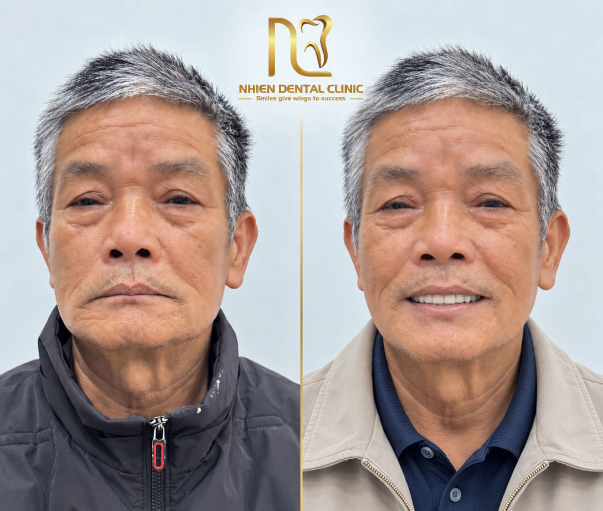 ham deo nha khoa nhien 3.jpg
