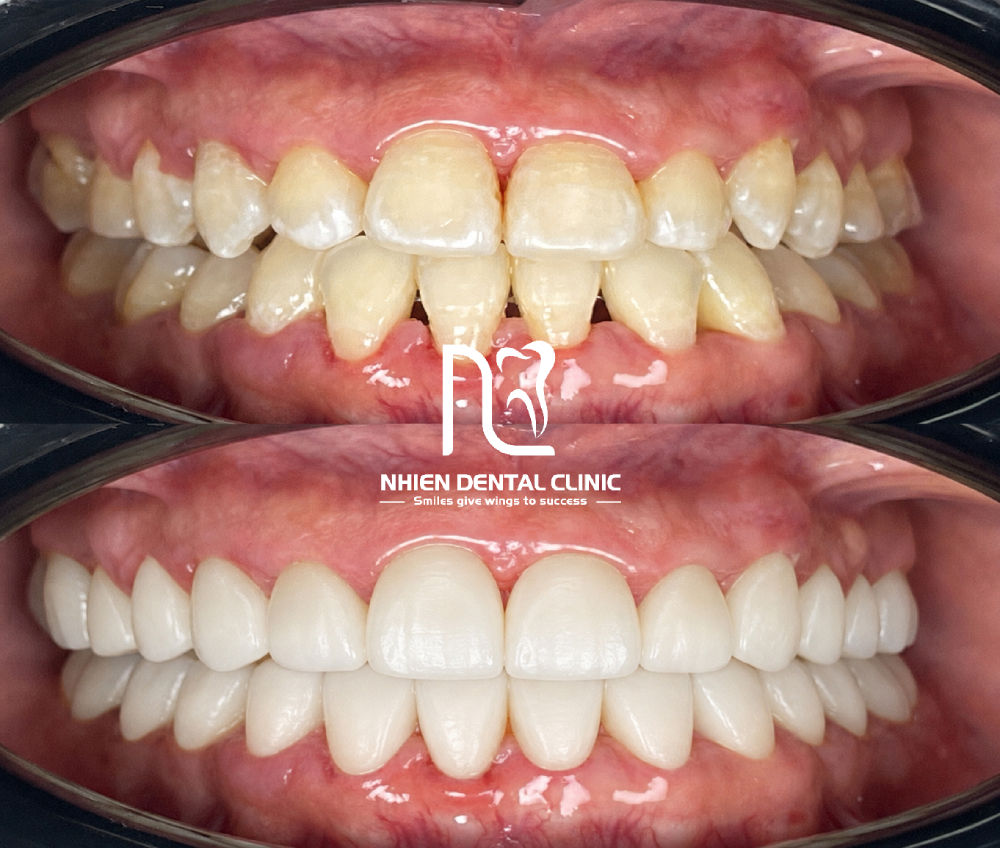 nha khoa nhien - orodent white matt 3.jpg