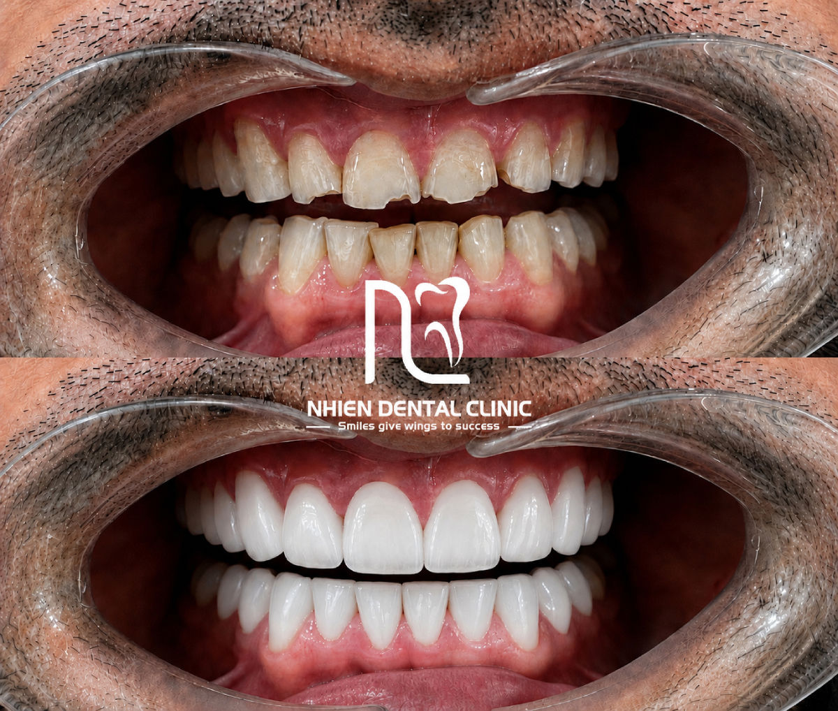 nha khoa nhien - orodent white bleach 6.jpg