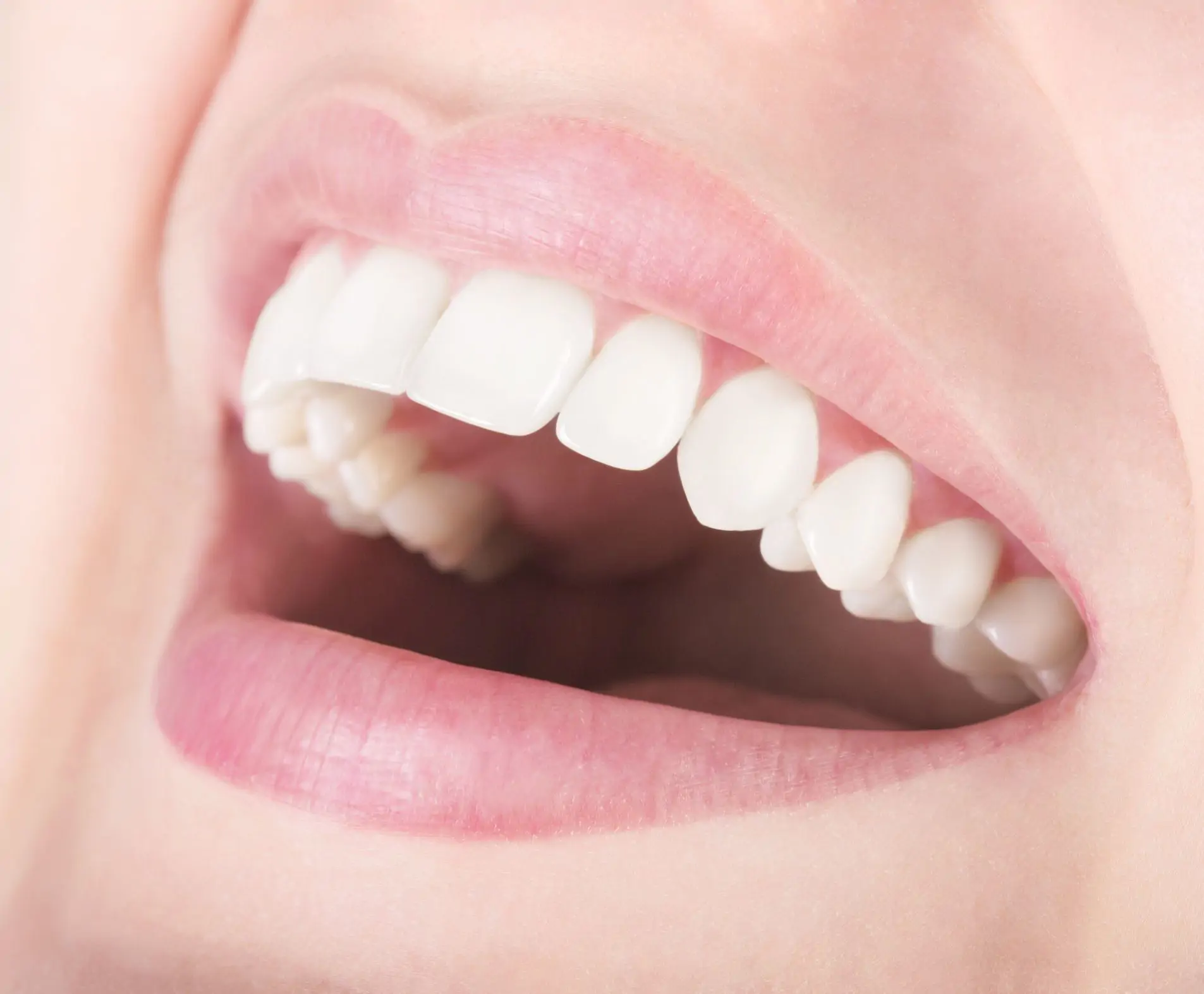 Răng sứ Venus Plus - Đức.