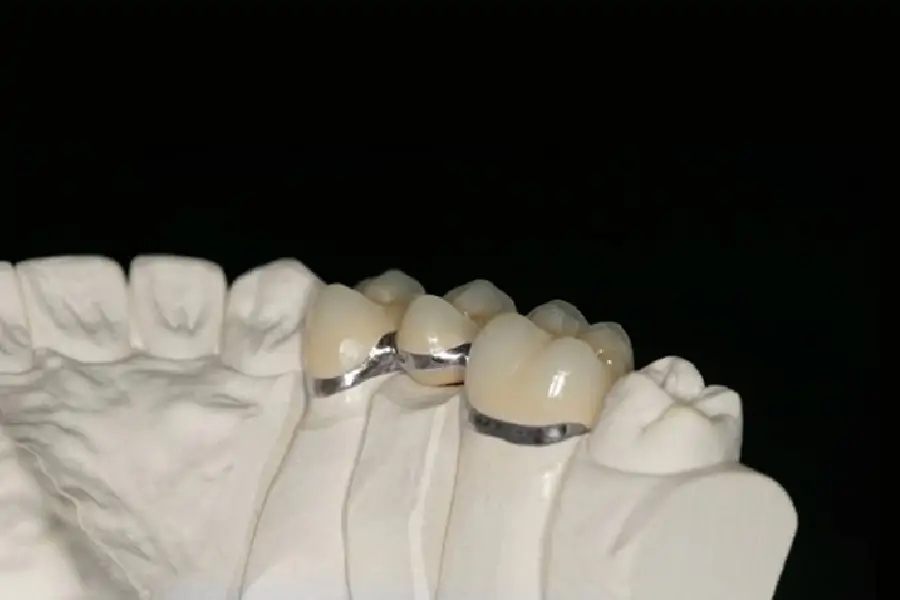 Răng kim loại quý - Titan