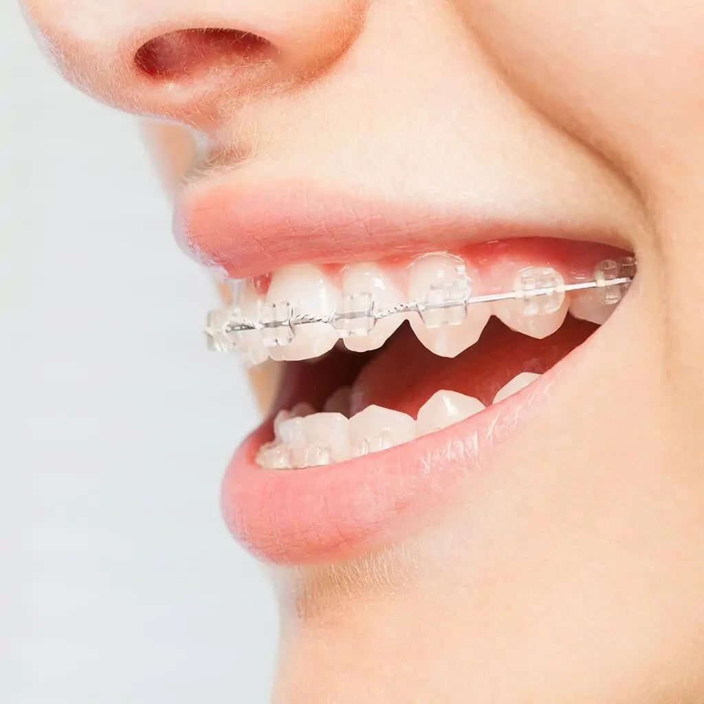 Mắc cài sứ thường