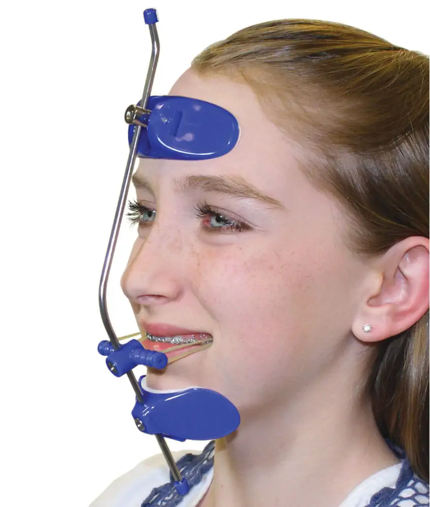 Hàm Facemask chỉnh cắn ngược